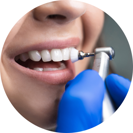before & after procedure of teeth whitening in pittsburgh, pa
